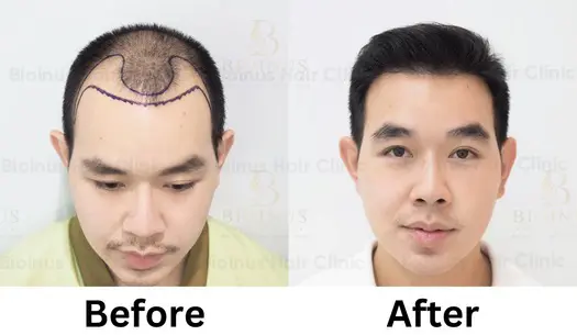 clinic for hair transplant